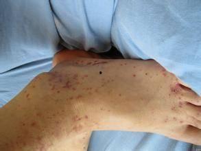 紫癜可以吃茄瓜,茄瓜的营养与益处