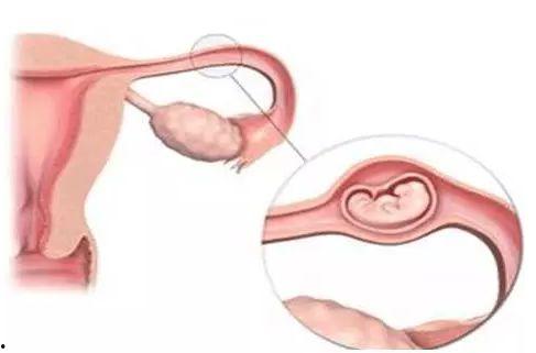 妇产科吃瓜宫外孕